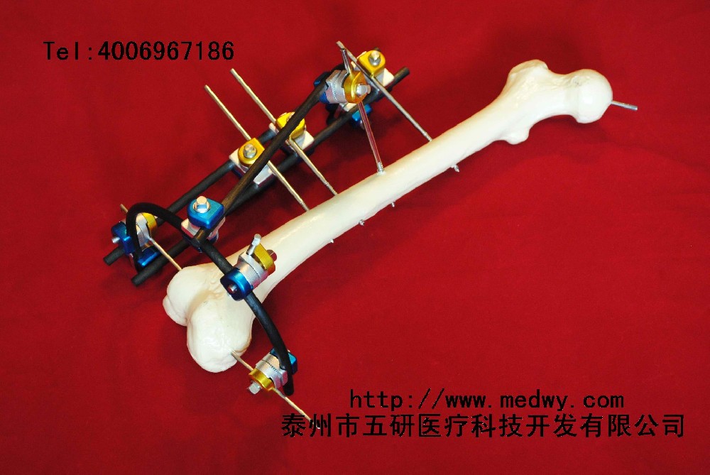 骨折、關(guān)節(jié)炎與四肢畸形患者福音