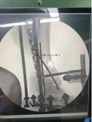 【最新病例】三臂十一軸機器人輔助器牽引——骨折外固定術(shù)骨折案例分享